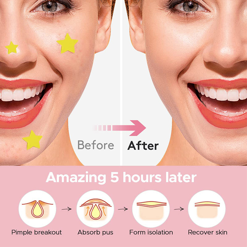 แผ่นแปะสิวรูปดาว 600 ชิ้น/ชุด  - Beauty Makeup & D Anime Studio บทวิจารณ์และราคา